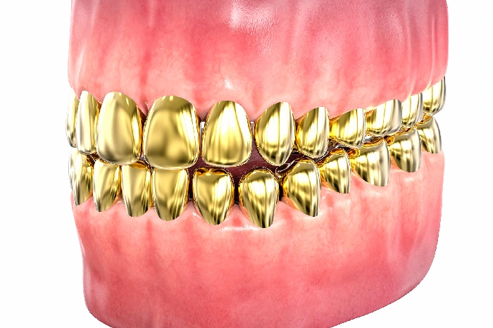 Gold Grillz Options For Different Tooth Alignments Columbus, GA Gold Grillz Options For Different Tooth Alignments Columbus, GA