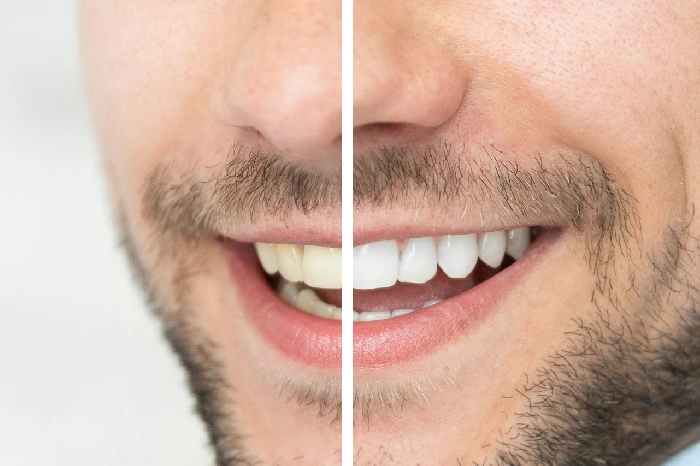 How Professional Teeth Whitening Improves Your Smile Columbus, GA How Professional Teeth Whitening Improves Your Smile Columbus, GA