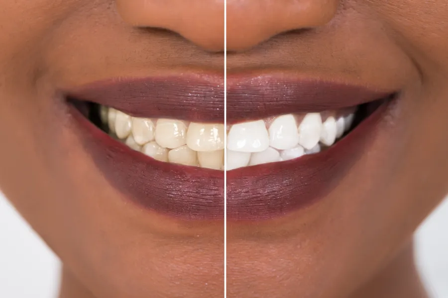 The Science Behind Safe Teeth Whitening Treatments Columbus, GA The Science Behind Safe Teeth Whitening Treatments Columbus, GA